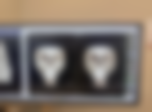 三、割双眼皮肉条感的评估参考