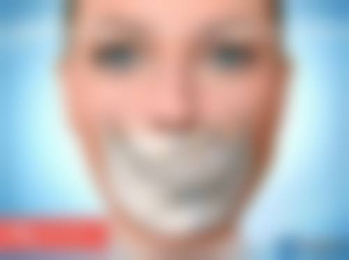 二、埋线双眼皮宽改窄的情况