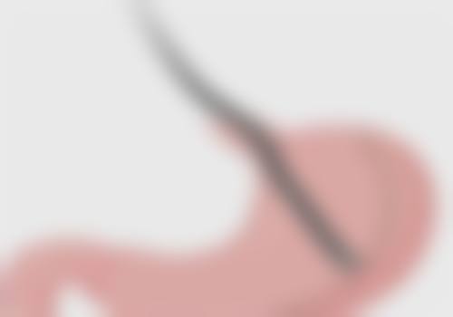 四、双眼皮做过埋线重新做的情况