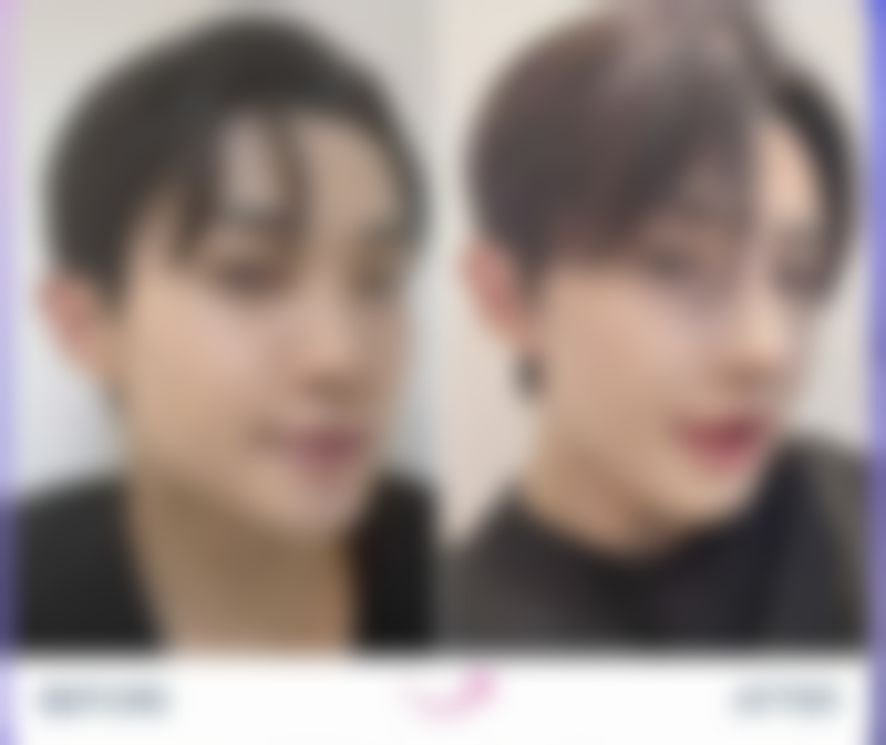 四、冬天做双眼皮的注意事项