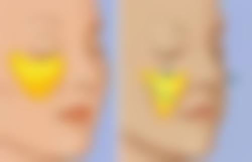 SRT - 100治疗疤痕疙瘩为什么还不能治好？解析其效果及难治愈原因 