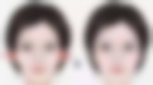 SRT - 100治疗疤痕疙瘩为什么还不能治好?总结一下