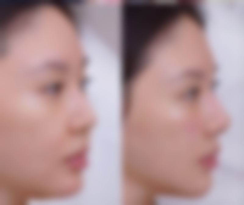 一、割完双眼皮吃桃的可行性分析