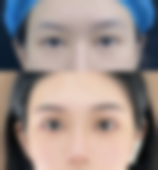 三、改善单双眼皮差异的方案