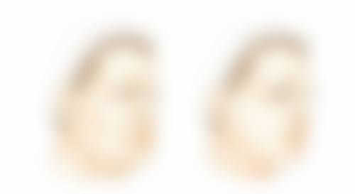 吸脂去眼袋有什么危害和后遗症？了解这些风险让你变美更安心