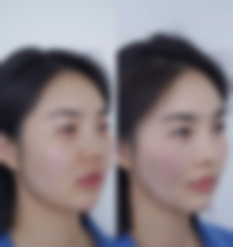 一、华美去除黑眼袋的常见手术方法