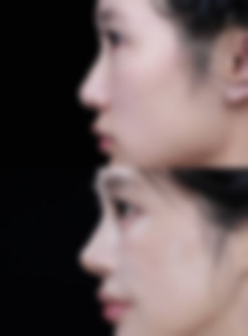 华美怎样有效去除黑眼袋？