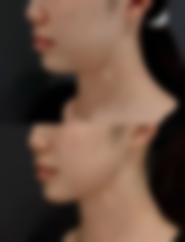 一、填充眼袋前要先了解眼袋成因