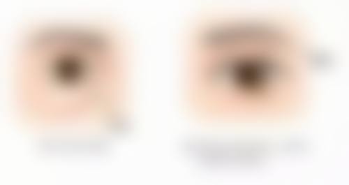 四、疤痕增生去疤之天然疗法辅助