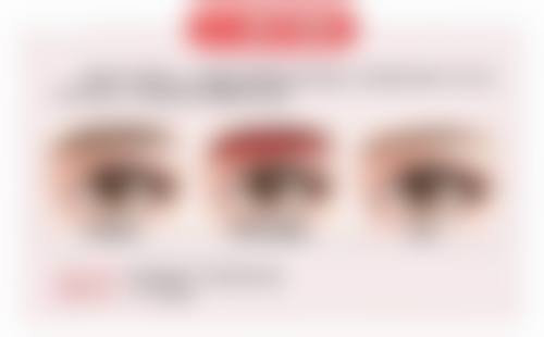 全切双眼皮睫毛外翻正常吗？解读恢复现象、异常表现及护理修复要点附图片参考