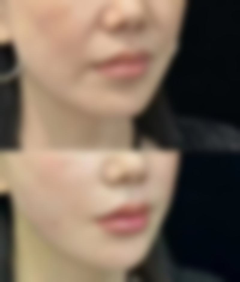 四、全切双眼皮睫毛外翻的修复方案