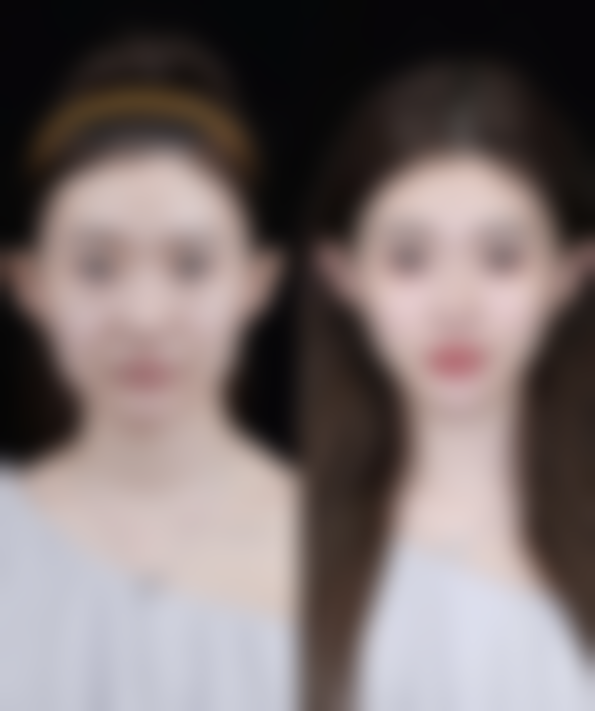 二、全切双眼皮睫毛外翻的评估参考