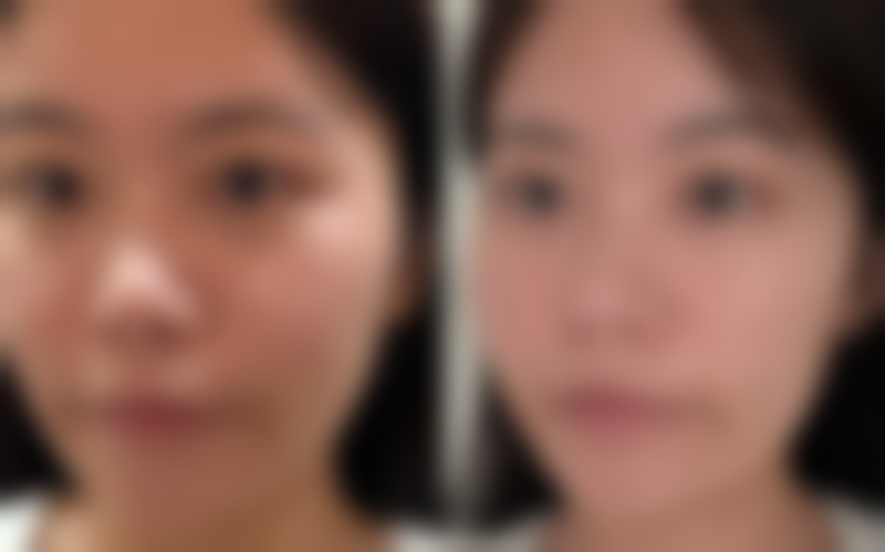 一、疤痕增生去疤之了解形成原因