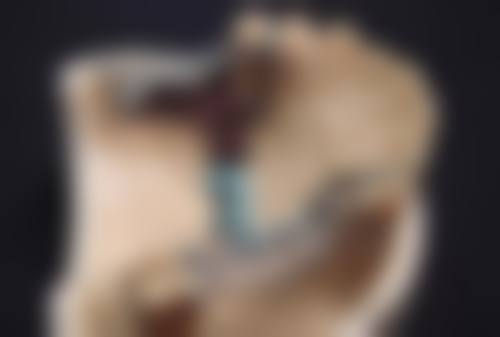 四、不同类型疤痕疙瘩的打针治疗原则