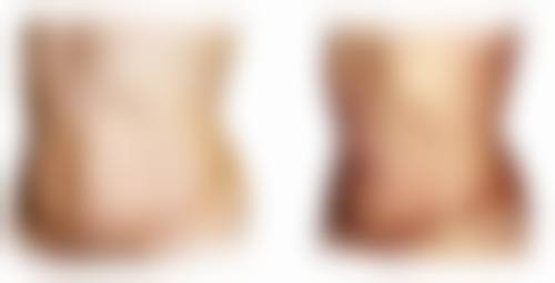 打针可以去除疤痕疙瘩吗？了解治疗效果、适用情况及注意事项，附参考图片 