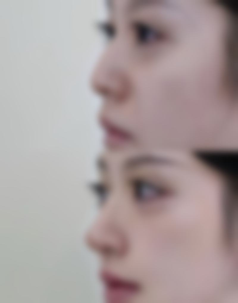 复合隆胸后要注意什么？伤口护理、胸部保养、生活习惯及复诊检查全攻略 