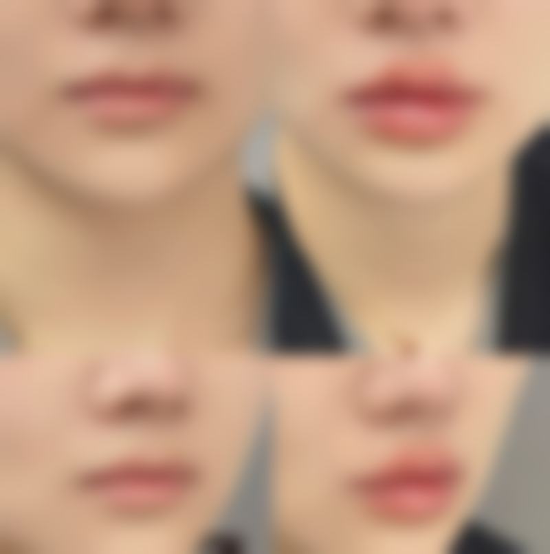 三、打针治疗的注意事项与风险