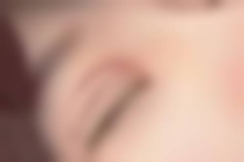 三、双眼皮割太窄的解决方案对比