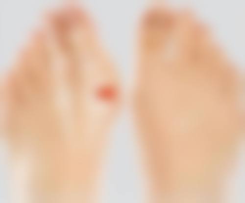 二、疤痕体质真的无法治疗吗