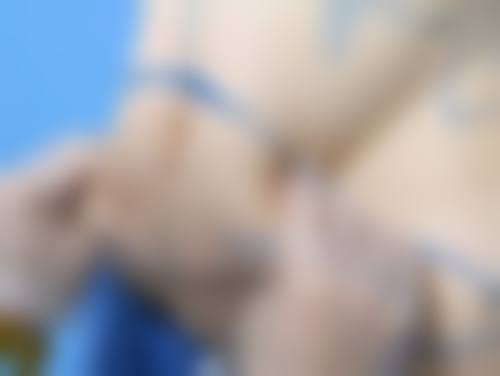 二、双眼皮割太窄的问题评估方向