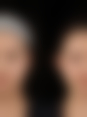 五、双眼皮割太窄修复的美学调整建议