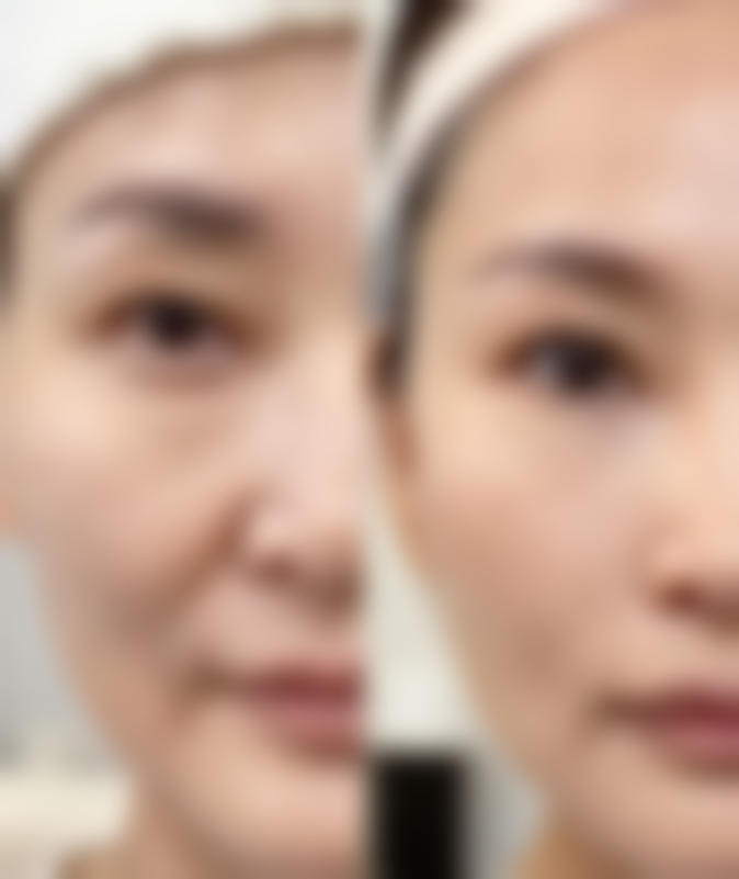 三、全身胖的人抽脂的手术风险