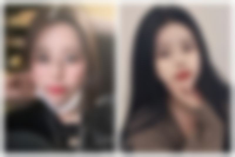 二、开刀做双眼皮的风险