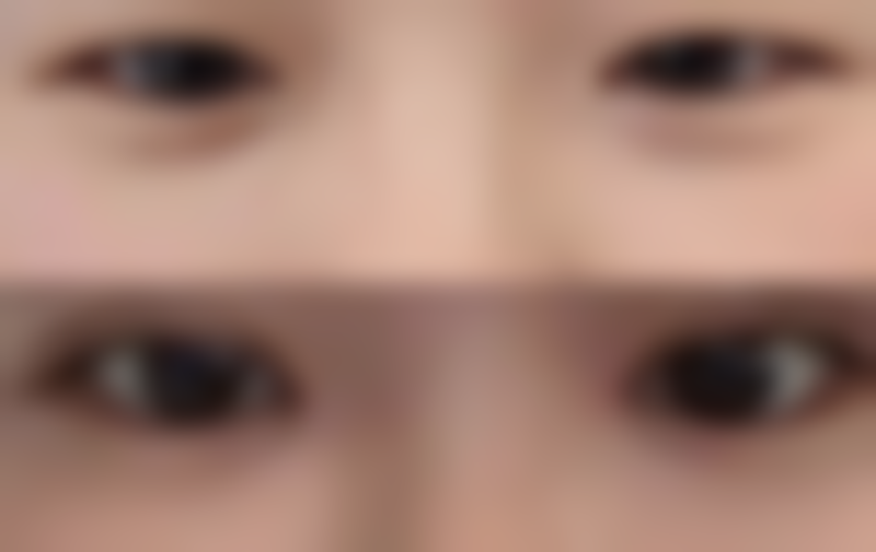 二、小时候烫伤的疤痕修复有无时间限制