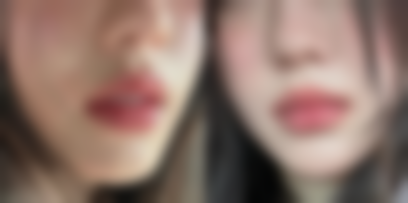 一、选择隆鼻方式需考虑的因素