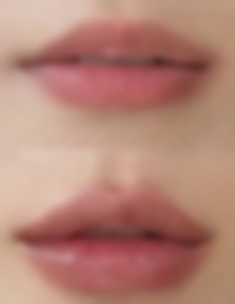 六、注射瘦脸针的注意事项