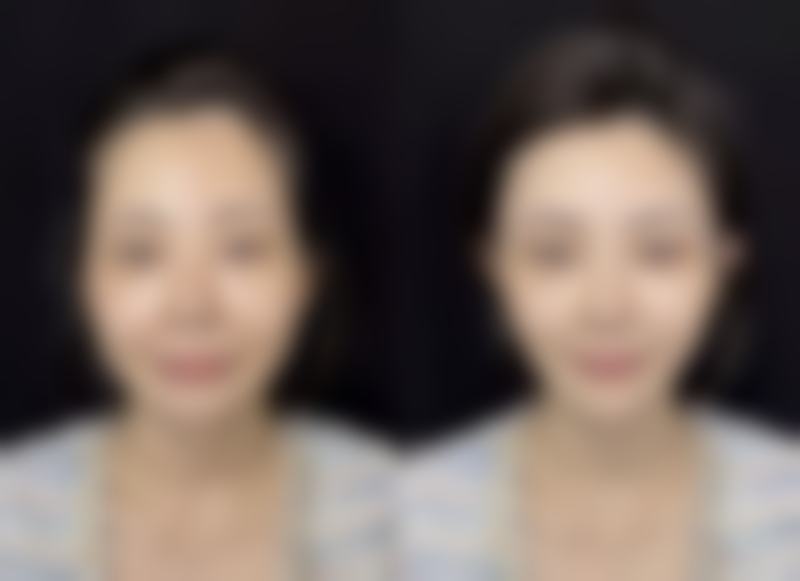 全切双眼皮多久疤痕消失正常？了解影响因素与恢复阶段，助你安心变美 