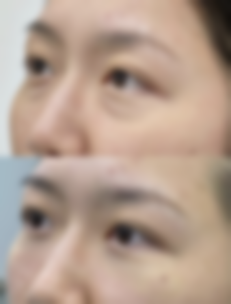 四、眼睛小做双眼皮的成效与局限性