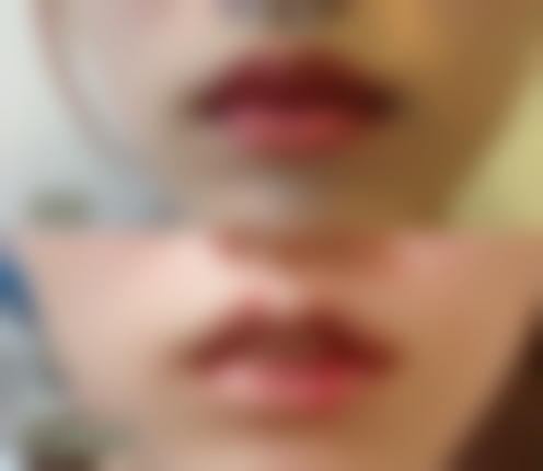 二、影响隆鼻假体留存时间的因素