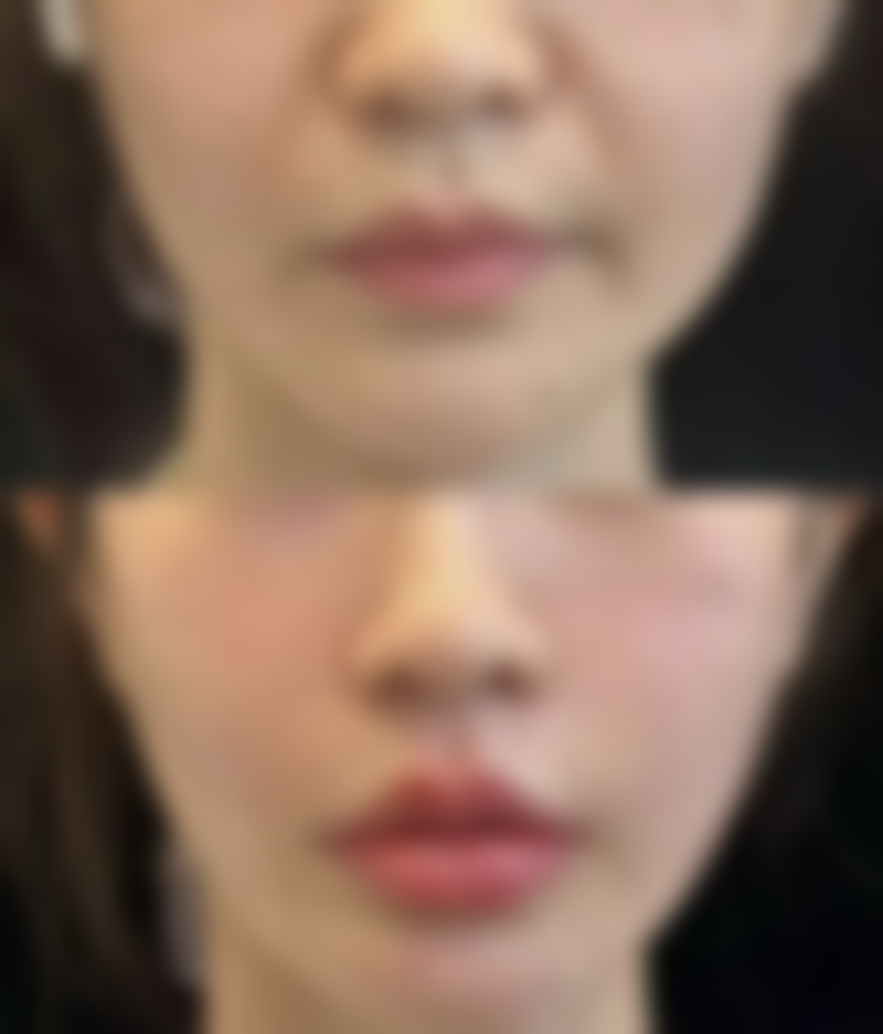 五、隆鼻手术的正确认知