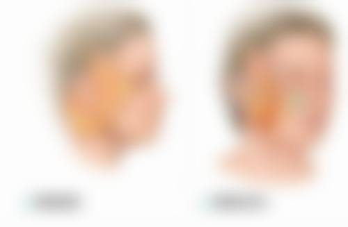 一、术后疤痕体质用药的重要性