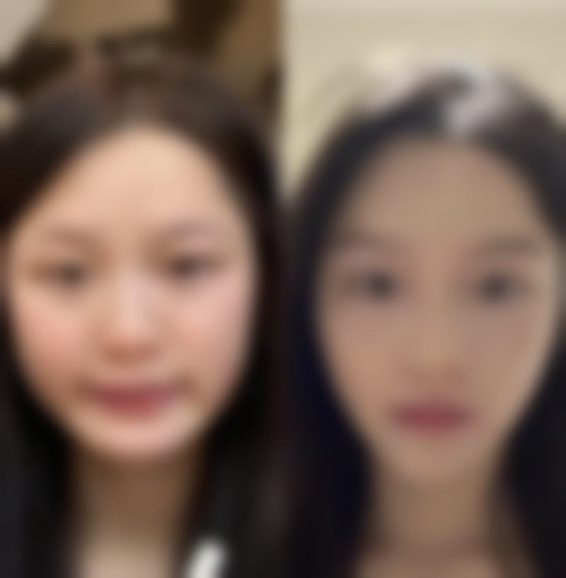 五、眼袋手术风险大吗？选择医生和机构特别重要