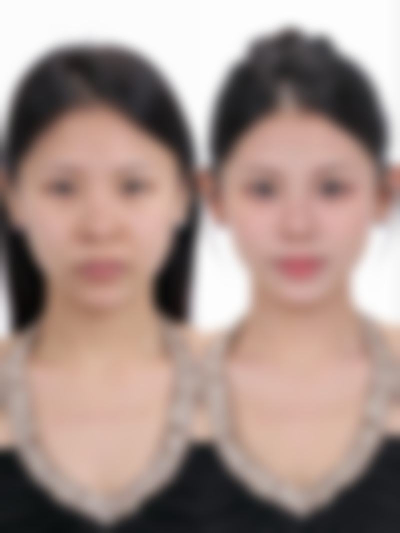 三、眼袋手术风险大吗？术前评估特别关键