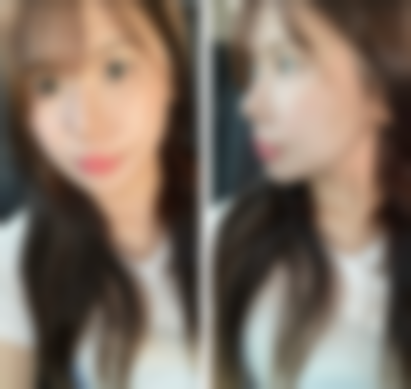 七、眼袋手术风险大吗？心理准备也特别必要