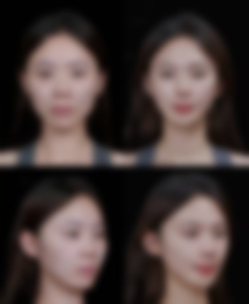 四、吸脂可以减体重吗？吸脂手术的危害及应对