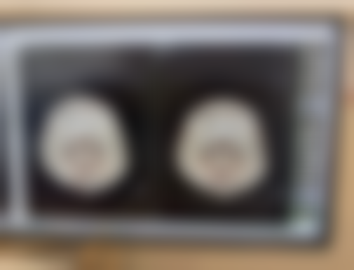 三、疤痕在面部怎么去除之日常护理辅助建议