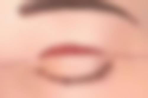 做双眼皮一个眼大一个眼小怎样修复好？多种方法助你实现对称自然美！ 