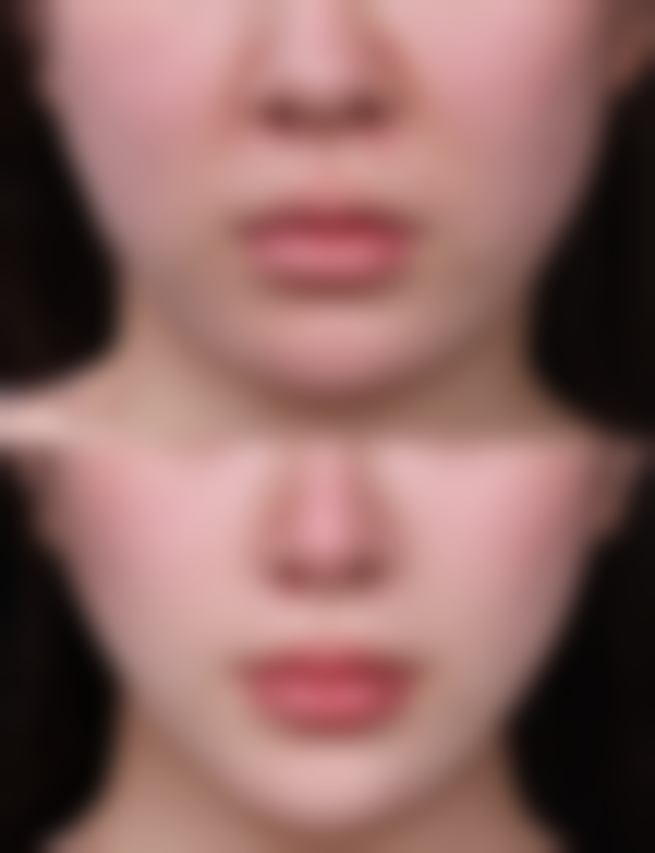 三、如何降低术后风险