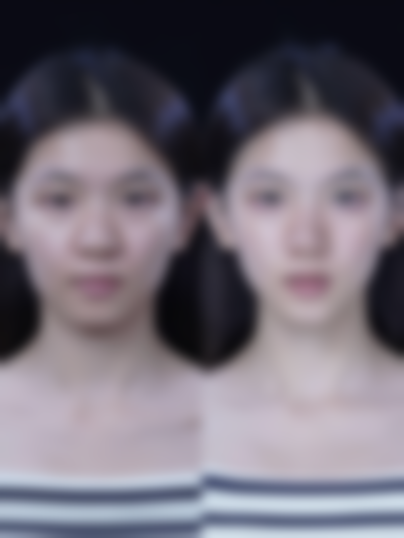 四、修复手术的注意事项