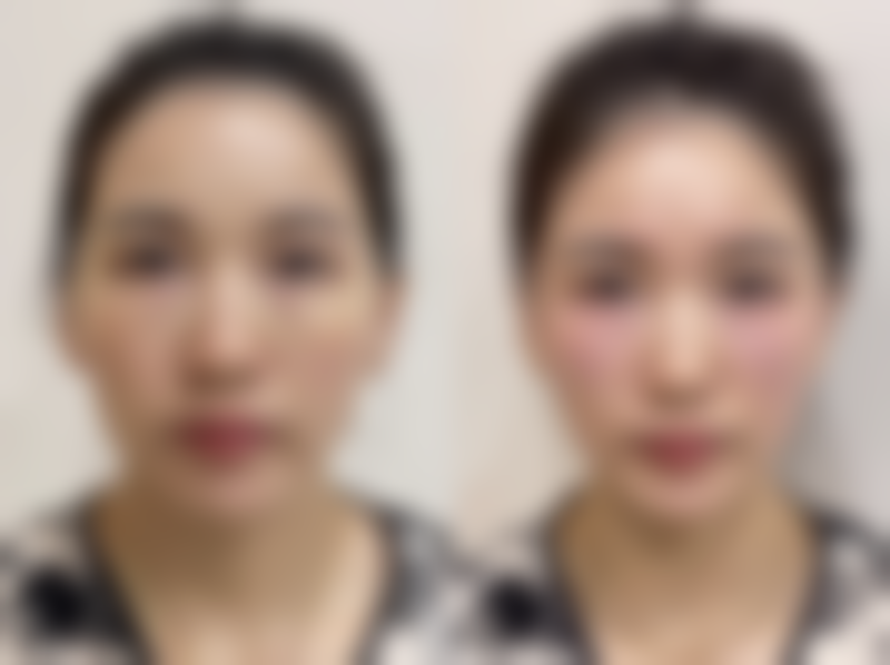 一、了解大小眼出现的原因