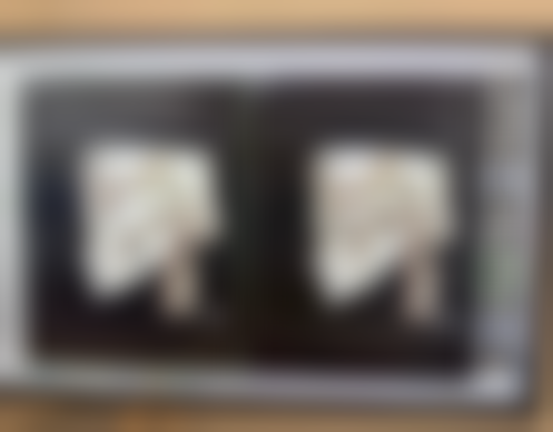 六、手术去眼袋费用参考