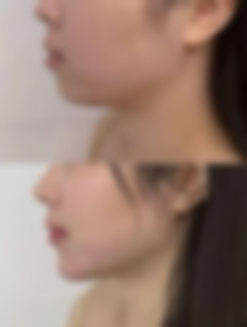 四、双眼皮全切多久修复自然