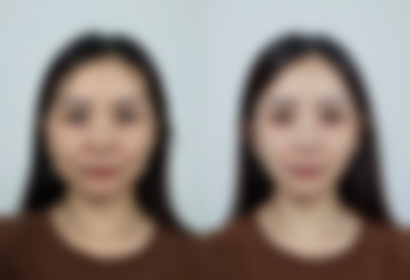 一、隆胸成效并非恒久