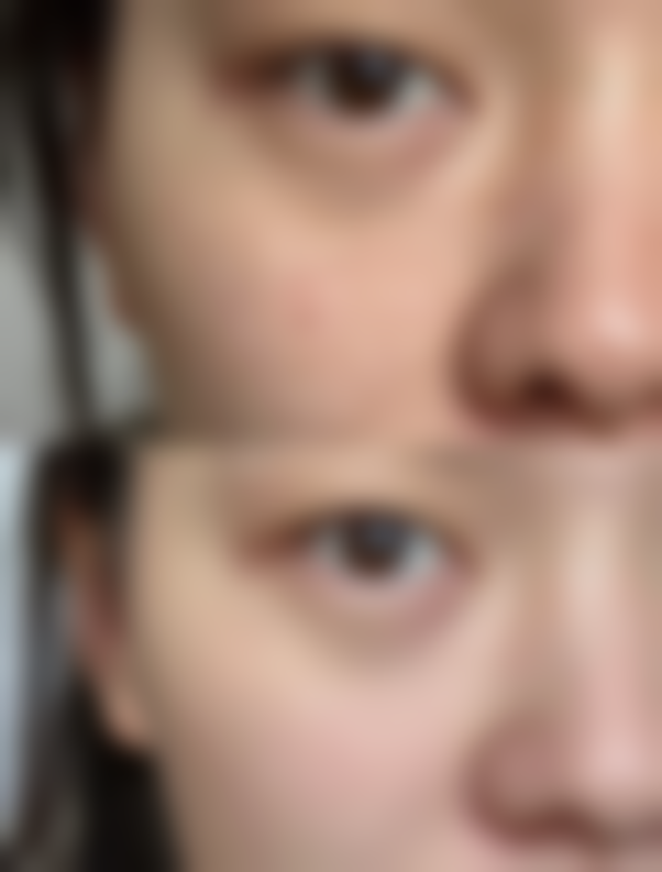 三、使用除皱针的注意事项