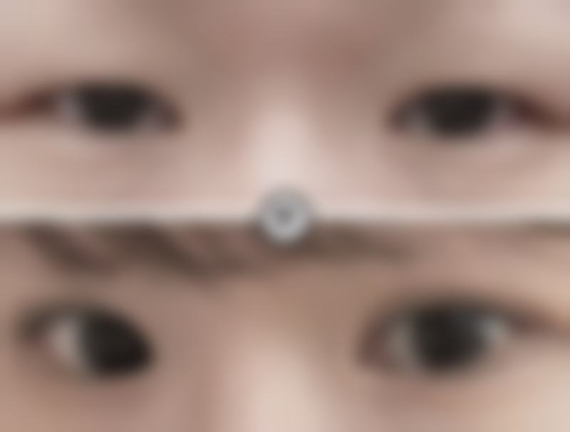 一、疤痕疙瘩特别痒越长越大的原因