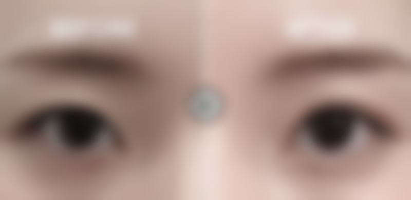 一、双眼皮全切手术时长